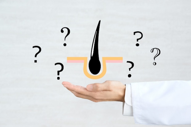 AGAとは？ 医師が解説！