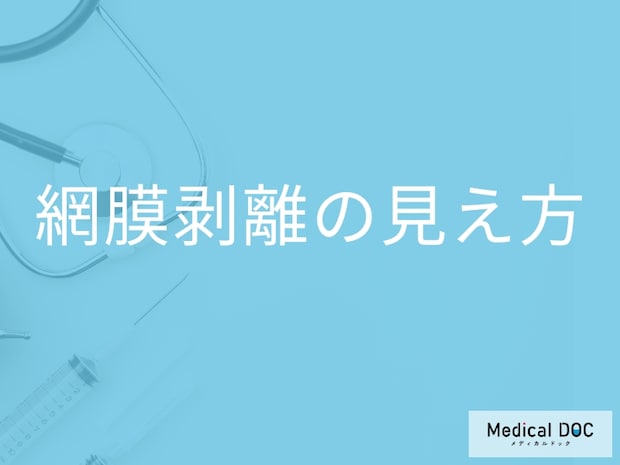 「網膜剝離」を発症するとどんな「見え方」になるかご存知ですか？初期の見え方も解説！