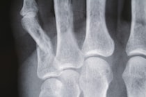 「ビールに用いられるホップが骨粗しょう症予防に効果的」このウワサを医学的な視点から解説