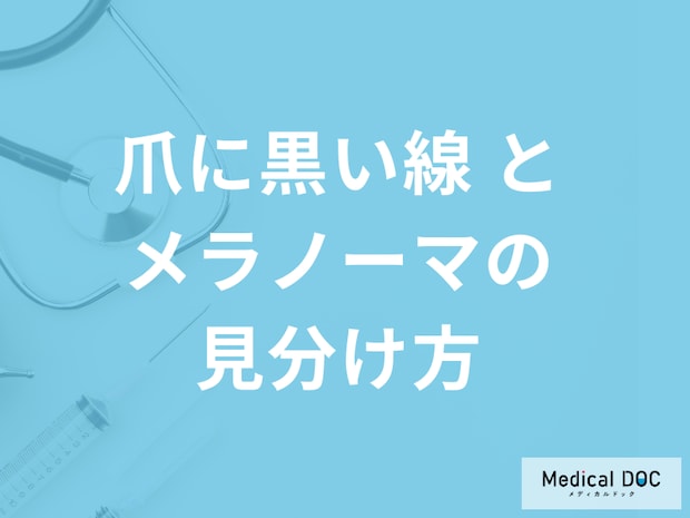 『爪に黒い線』が出たとき「メラノーマと別の疾患との見分け方」は？医師が解説！
