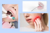 歯が痛い！原因は虫歯だけじゃないんです！痛みが起こるメカニズムまとめ