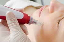 ニキビ跡や毛穴汚れに使う「ダーマペン」、効果や治療期間・回数などの気になる点を皮膚科医が解説