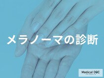 日本人は足の裏や爪に多い！増加傾向のメラノーマの特徴と、確定診断までの流れ