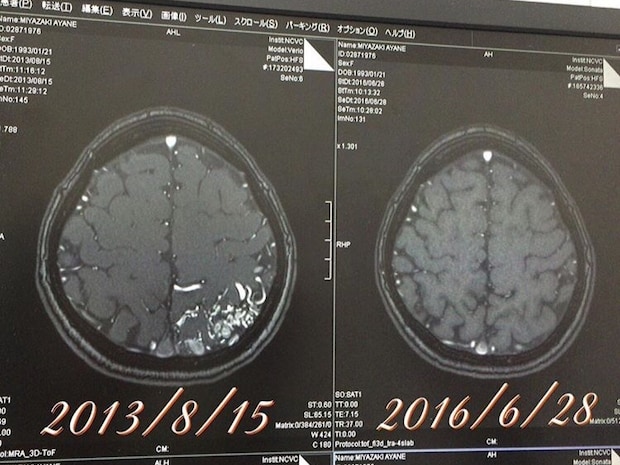 頭痛なのに、脳の病気が疑われていなかった width=