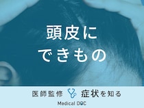「頭皮にできもの」ができる原因はご存知ですか？医師が監修！