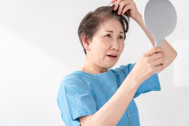 女性の「薄毛治療」を医師が解説 男性のAGAと違うの? 植毛も男性だけのものではない