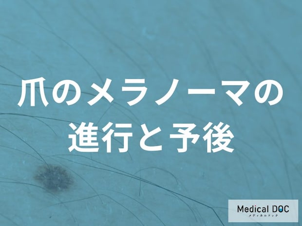 日本人に多い爪メラノーマ|治る確率は?早期発見のポイントと受診目安