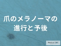 日本人に多い爪メラノーマ｜治る確率は？早期発見のポイントと受診目安