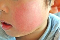 「りんご病」とは？症状や大人が発症した場合についても解説！