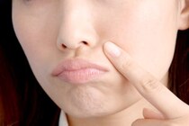 尋常性ざ瘡（にきび）の症状や原因、治療方法とは？