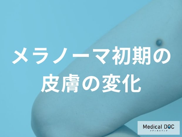 痛みがなくても要注意！メラノーマの初期症状と皮膚科を受診すべきサイン