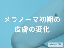 痛みがなくても要注意！メラノーマの初期症状と皮膚科を受診すべきサイン