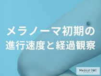 メラノーマの進行速度は？初期の変化に気づくためのポイントを医師が解説