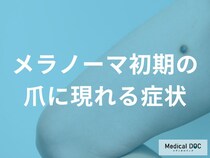 爪に黒い線ができたら要注意！メラノーマを見分けるポイントと受診目安