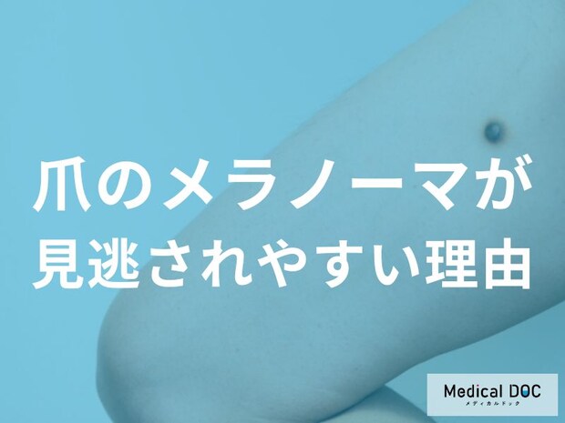 爪のメラノーマは見逃されやすい？ネイルや外傷と勘違いしてしまう理由を医師解説