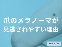 爪のメラノーマは見逃されやすい？ネイルや外傷と勘違いしてしまう理由を医師解説