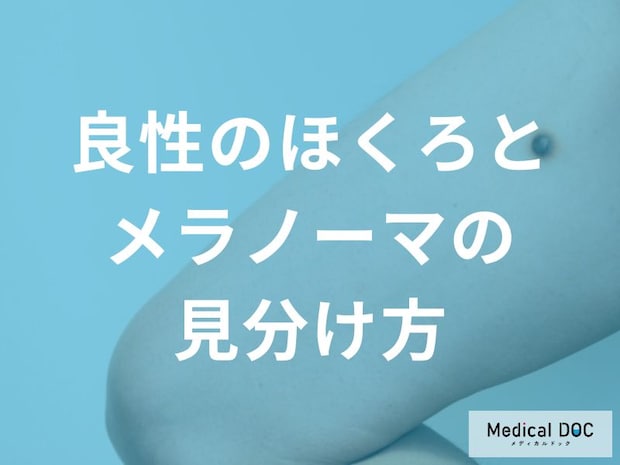「良いほくろ」と「悪いほくろ」の違いは？自分で確認できる5つのポイント
