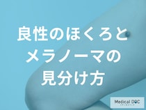 「良いほくろ」と「悪いほくろ」の違いは？自分で確認できる5つのポイント