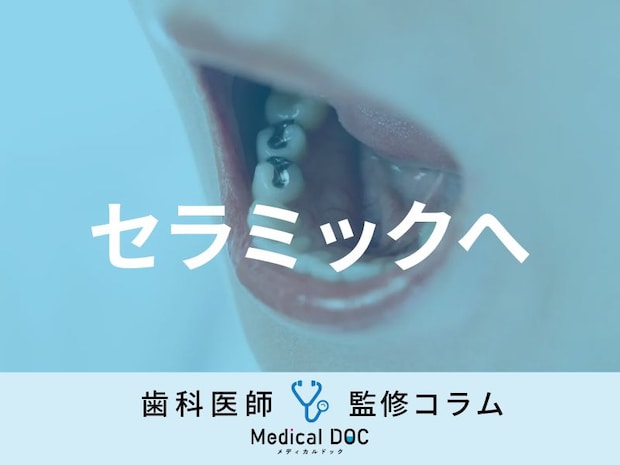 数年前に入れた差し歯・銀歯を「セラミック」に変えるには何に気を付けたらいい？【歯科医解説】