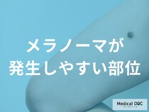 多いのは「足の裏」？メラノーマが発生しやすい部位と特徴を医師が解説