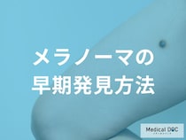 背中や頭皮は大丈夫？見えにくい場所のメラノーマを見つけるコツを医師が解説