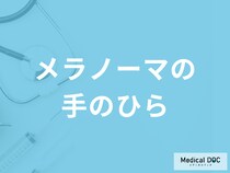 「メラノーマは手のひら」にできやすい？できやすい場所や症状も医師が解説！