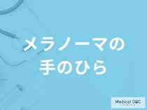 「メラノーマは手のひら」にできやすい？できやすい場所や症状も医師が解説！