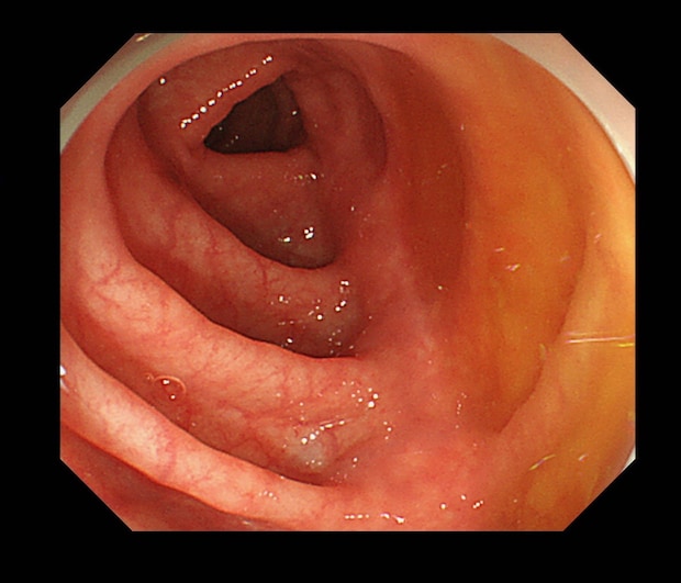 大腸カメラについて医師が解説！