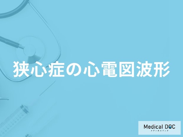 「狭心症」を疑う「心電図の波形」にはどんな特徴がある？【医師解説】