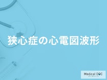 「狭心症」を疑う「心電図の波形」にはどんな特徴がある？【医師解説】