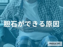 「胆石」ができやすい人の特徴とは？食生活の欧米化やホルモンバランスとの関係【医師解説】