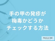 「手の甲に出来た発疹」にどのような特徴があれば「梅毒」を疑った方がいい？【医師監修】