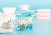 根管治療のやり直し(再根管治療)ってどうやるの? 再治療になる原因や対策を歯科医が解説