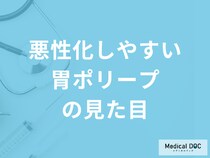 ”悪性化”しやすい「胃ポリープの見た目」は？進行時の症状も医師が解説！
