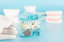 根管治療のやり直し(再根管治療)ってどうやるの? 再治療になる原因や対策を歯科医が解説