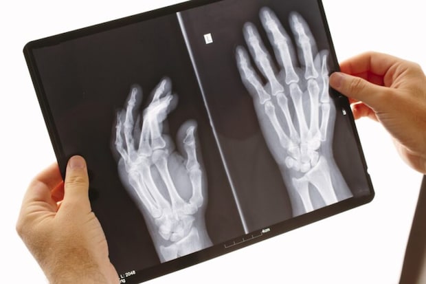 手のX線写真