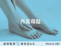 「外反母趾」とは？治療法・原因・予防法についても解説！医師が監修！