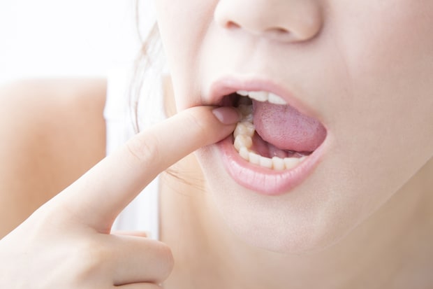 ただの口内炎だと思っていたら……