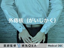 「外痔核」とは？治療法・原因・薬についても解説！【医師監修】