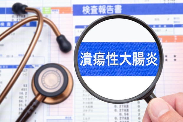 潰瘍性大腸炎とは？ 医師が解説