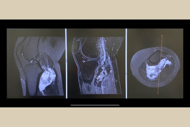 歩くのも困難なほどの痛みが、まさかの「滑膜肉腫」だった