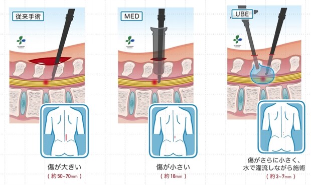 脊椎内視鏡手術