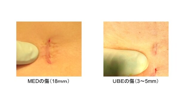 脊椎内視鏡手術の傷