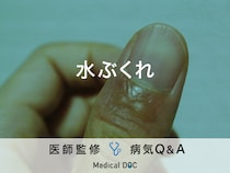 「水ぶくれ」ができるメカニズムはご存知ですか？医師が監修！