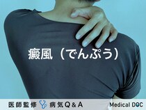 「癜風（でんぷう） 」とは？放置するとどうなるか・原因・治療法も解説！