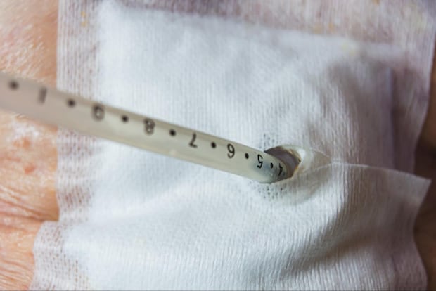 胃ろうでよくあるトラブル