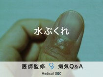 「水ぶくれ」ができるメカニズムはご存知ですか？医師が監修！
