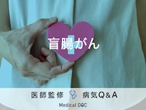 「盲腸がん」の初期症状・「大腸がん」との違いはご存知ですか？医師が監修！