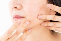 シミの原因と治療法を皮膚科医が解説 紫外線･活性酸素･年齢への正しい対策とは？