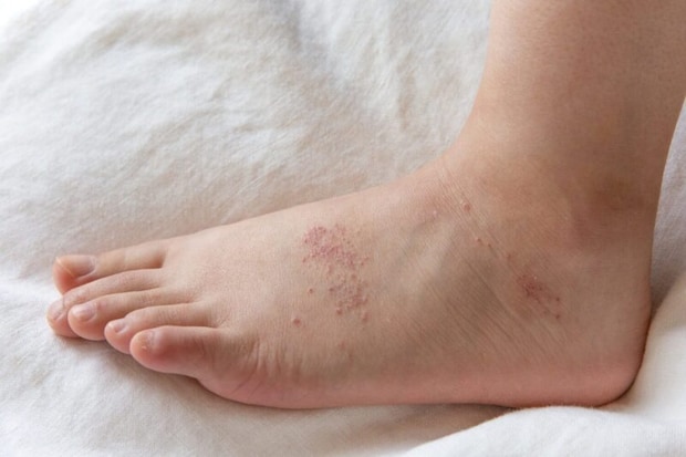 湿疹のある足